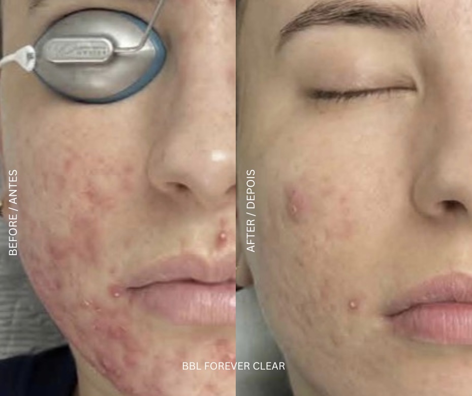 BBL by Sciton laser treatment device at AD Lisbon